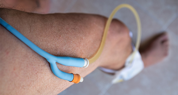 a tube of a catheter going down into a catheter bag